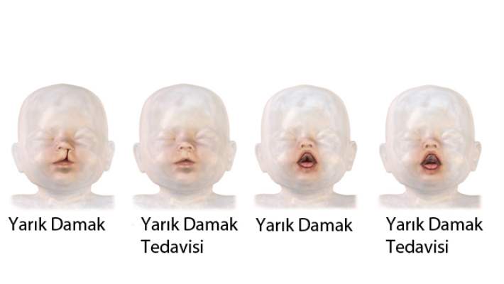 Çocuklarda Damak Yarığına Dikkat