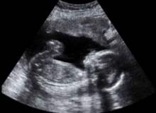 Hamileliğin 3. haftasında neler yaşanır? Hamileliğin 3. haftasında neler yaşanır?