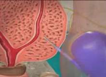 Her Yıl 679 Bin Kişi Prostata Yakalanıyor Her Yıl 679 Bin Kişi Prostata Yakalanıyor