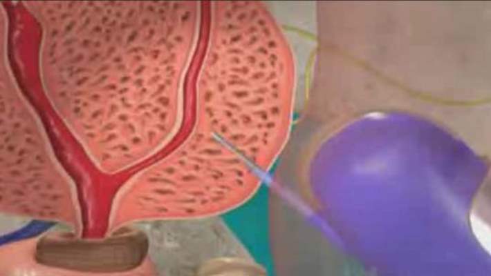 Her Yıl 679 Bin Kişi Prostata Yakalanıyor