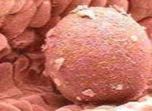 Yumurtlama bozukluğunun nedeni nedir? Yumurtlama bozukluğunun nedeni nedir?