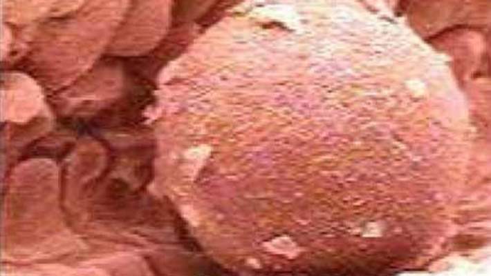 Yumurtlama Bozukluğunun Nedeni Nedir?