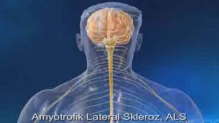 Als Hastalığına Neden Olan Gen Bulundu