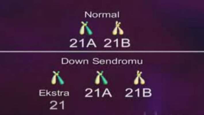 Down Sendromu Riskini Artıran Faktörler Nelerdir?