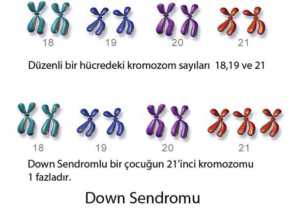 Yeni doğanlarda Down Sendromu belirtileri nelerdir?