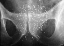 E Vitamini Prostat Kanseri Riskini Artırabilir E Vitamini Prostat Kanseri Riskini Artırabilir