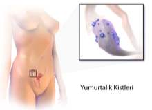 Doğurganlık Tedavisi Yumurtalık Tümörü Riskini Artırıyor Doğurganlık Tedavisi Yumurtalık Tümörü Riskini Artırıyor