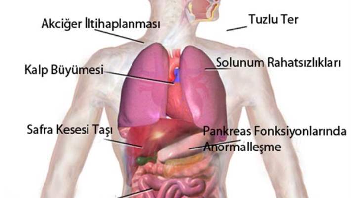 Fibroz Nedir?