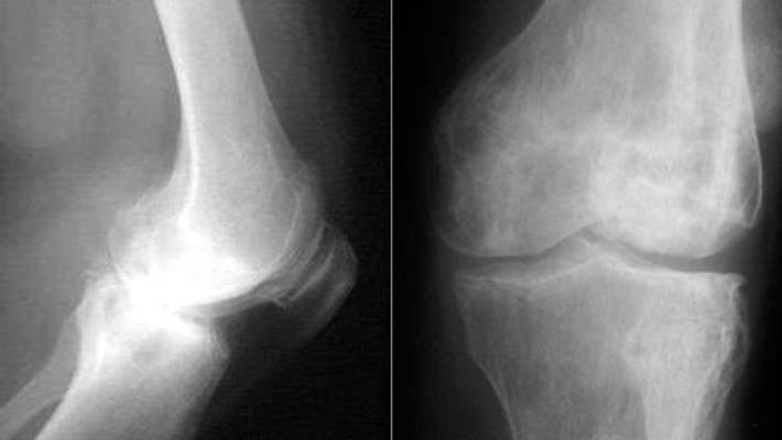 Dizde Kıkırdak Tahribatına Robotik Cerrahi