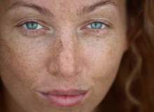 Hiperpigmentasyon, Hipopigmentasyon ve Deriniz Hiperpigmentasyon, Hipopigmentasyon ve Deriniz