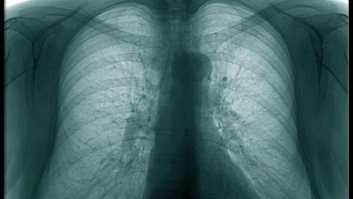 Röntgen Akciğer Kanserinin Erken Teşhisinde İşe Yaramıyor