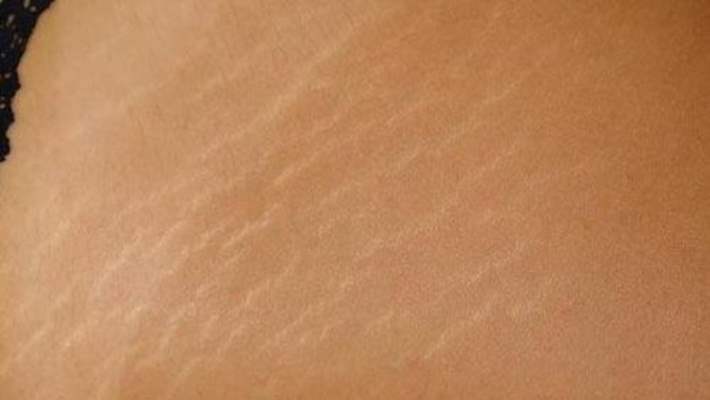 Doğum Çatlaklarının Oluşmasında Hangi Faktörler Rol Oynar?