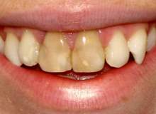 Diş Çürüğü Görülme Oranı Yüzde Doksanların Üzerinde