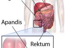 Çocuklarda apandisit daha çabuk patlıyor Çocuklarda apandisit daha çabuk patlıyor