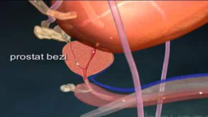 Benign Prostat Hiperplazisi (Prostatta İyi Huylu Büyüme)