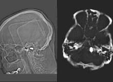 Mühendis, Başında Mermiyle 80 Yıl Yaşadı Mühendis, Başında Mermiyle 80 Yıl Yaşadı