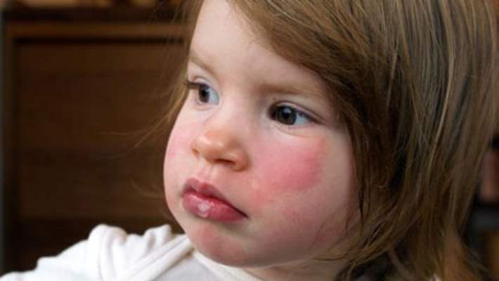 Çocuklar Alerjik Hastalıklardan Muzdarip