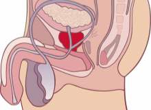 Her 12 Erkekten Biri Prostat Kanseri Her 12 Erkekten Biri Prostat Kanseri