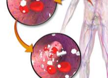 Diyabetle Kanser İlişkisi Diyabetle Kanser İlişkisi