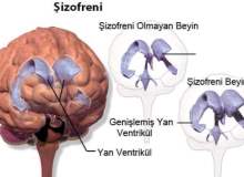 Şizofreni Tedavisinde En Etkili Yöntem İlaç