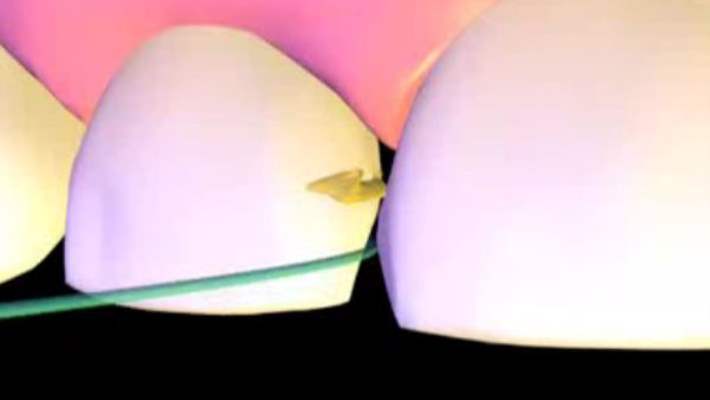 Yaprak Porseleninden Hoşnut Olmayanlar Ne Yapmalı?