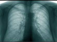 Akciğer amfizemi tedavi edilmezse ne olur?