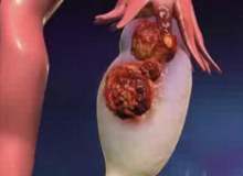 Uzun Boylu Kadınlarda Yumurtalık Kanseri Riski Daha Fazla Uzun Boylu Kadınlarda Yumurtalık Kanseri Riski Daha Fazla