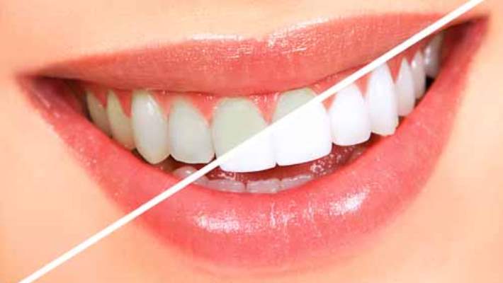 Tedavi Sonrası Diş Nasıl Görünecek?
