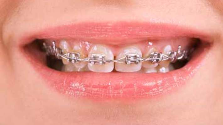 Ortodontik Tedavi Yetişkinlere De (Tel Tedavisi) Uygulanabilir Mi?