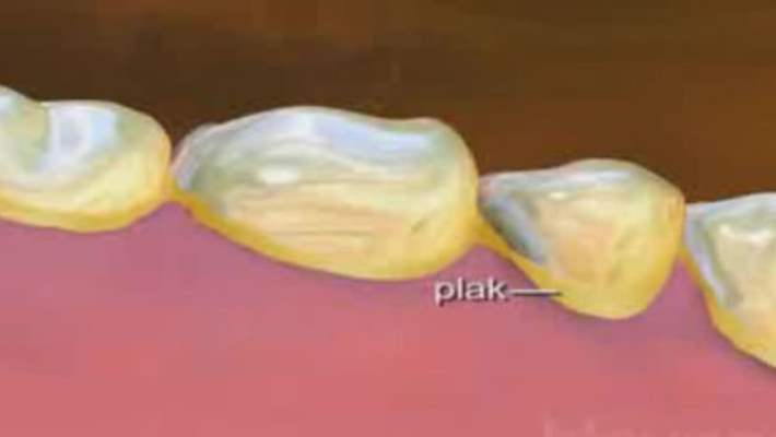 Diş Taşları Temizlenirken Dişler Zarar Görür Mü?