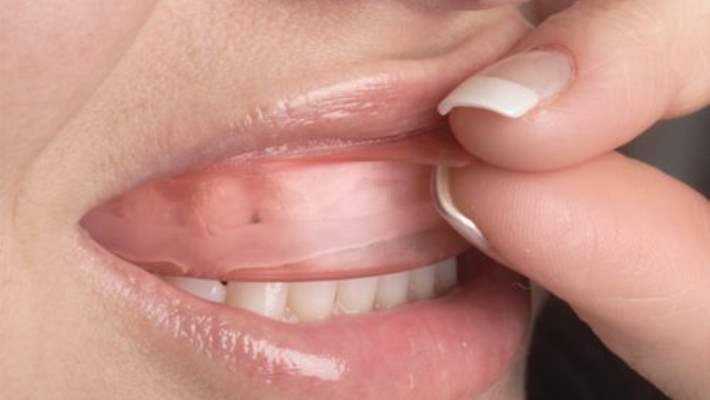 Diş Beyazlatma İşlemi Nasıl Yapılır?