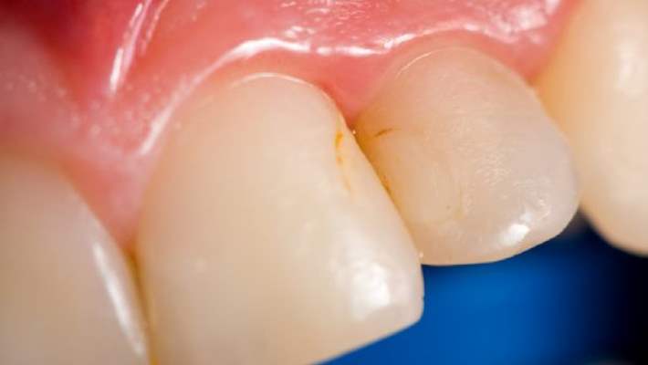 Kürdan Dişler İçin Zararlı Mıdır?