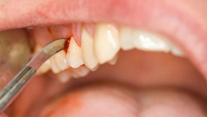Diş Apsesi Nasıl Tedavi Edilir?