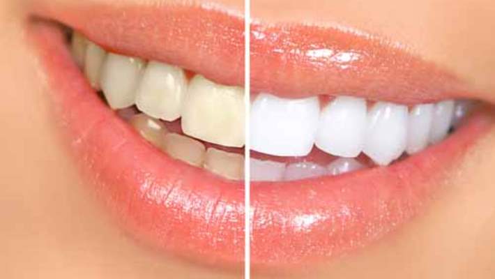 Evde Diş Beyazlatma Ürünleri Sağlıklı Mıdır?