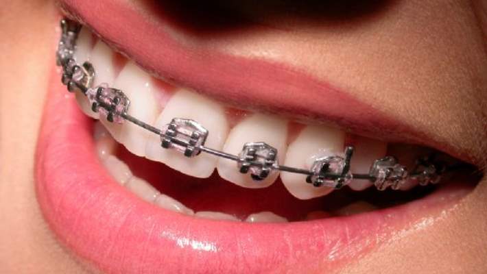 Yetişkinler İçin Estetik Diş Telleri Mi Kullanılır?