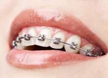 Diş teli hangi sorunlarda kullanılır?