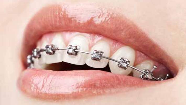 Diş Teli Hangi Sorunlarda Kullanılır?