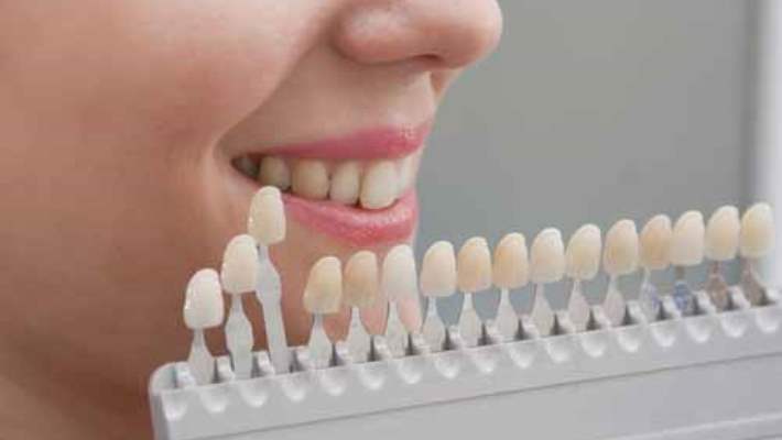 Lazer İle Diş Beyazlatma Yöntemi Nedir?