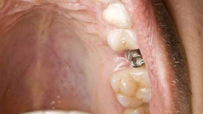 İmplant Diş Tedavisinin Aşamaları Nelerdir?
