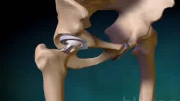 Kalça Yüzey Kaplama (Resurfacing) Protezleri