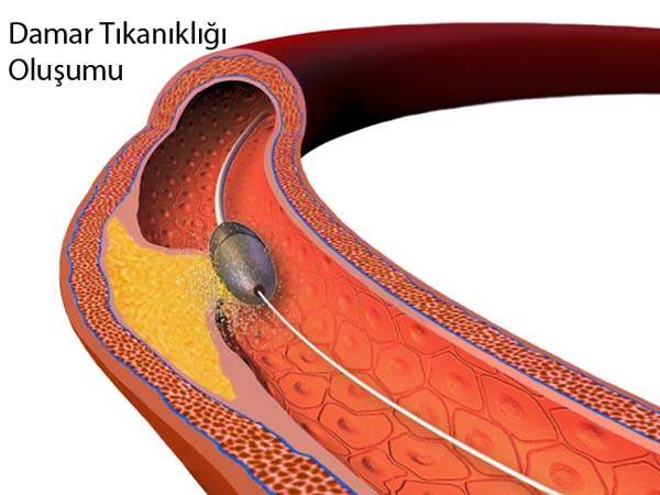 Damar rahatsızlıklarında uygulanan tedaviler