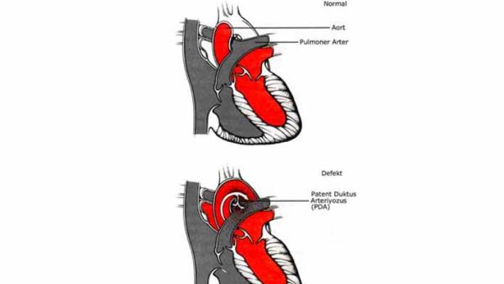 Patent Duktus Arteriyozus (Pda)