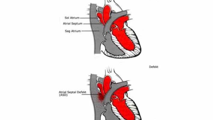 Atriyal Septal Defekt (Asd)