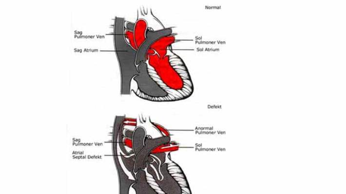 Akciğerden Kalbe Kanın Dönüş Anomalisi