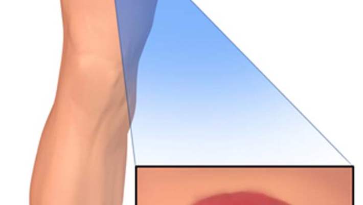 Lyme Hastalığının Önlenmesi