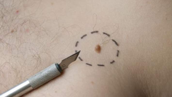 Et Beni Şeker Hastalığının Habercisi