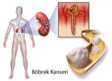 Kronik böbrek yetmezliğinin nedenleri
