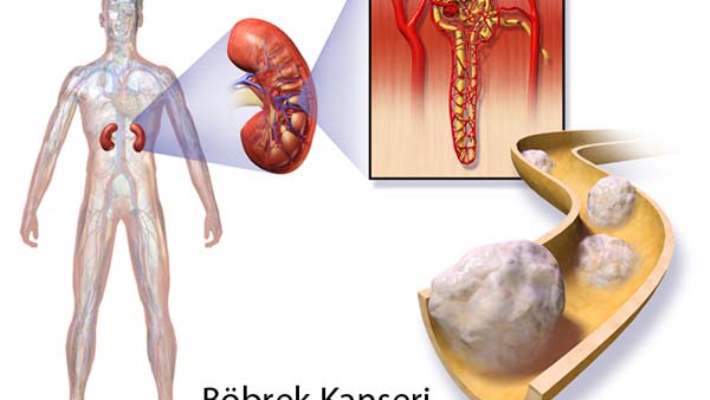 Kronik Böbrek Yetmezliğinin Nedenleri