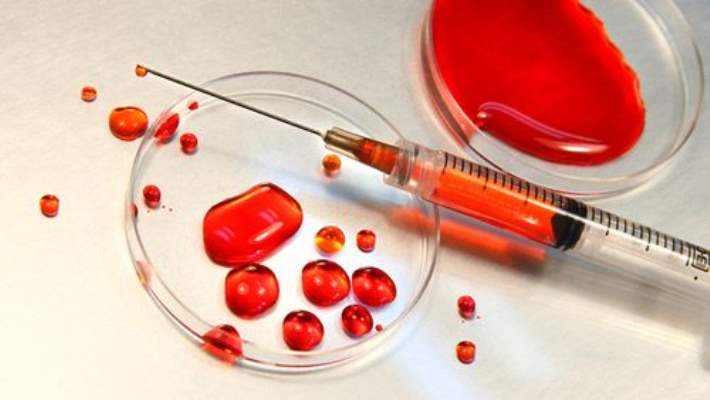 Kan Grubu Ve Pankreas Kanseri Birbiriyle Bağlantılı