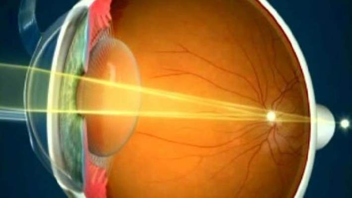 Lazer Tedavisiyle Gözlükten Kurtulma